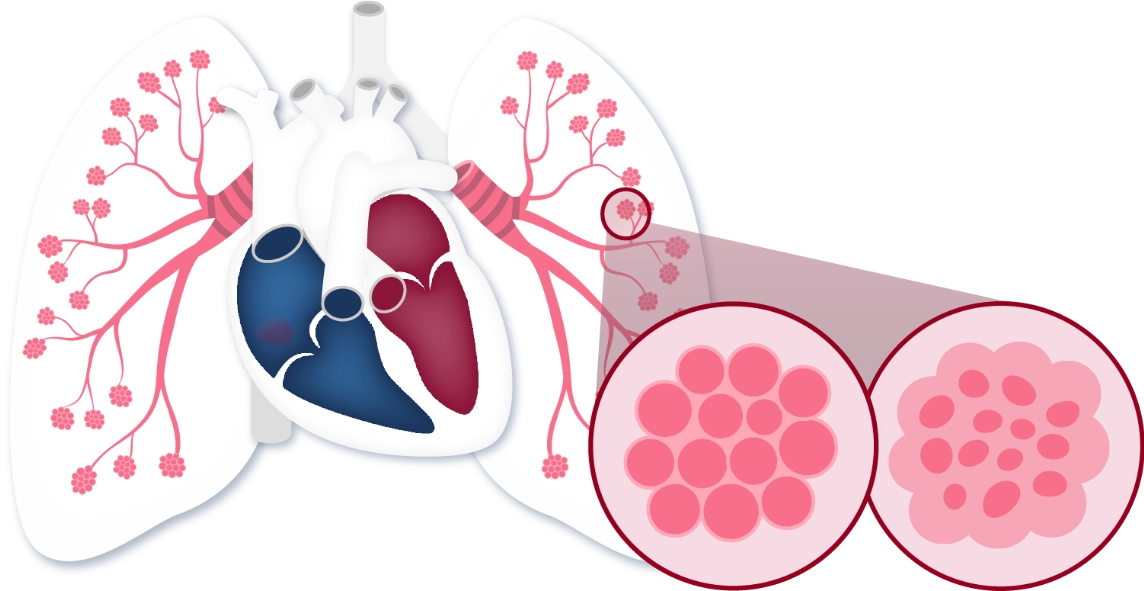 Anatomical depiction of Pulmonary Hypertension Associated with Interstitial Lung Disease (or PH-ILD) presentations in the respiratory system